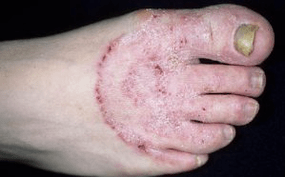 Motivele apariției ciupercii pe picioare