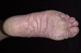 Semne și simptome ale ciupercii pe picioare