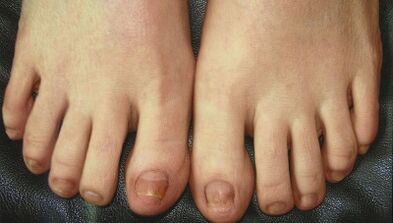 Etape de dezvoltare a ciupercii de unghii