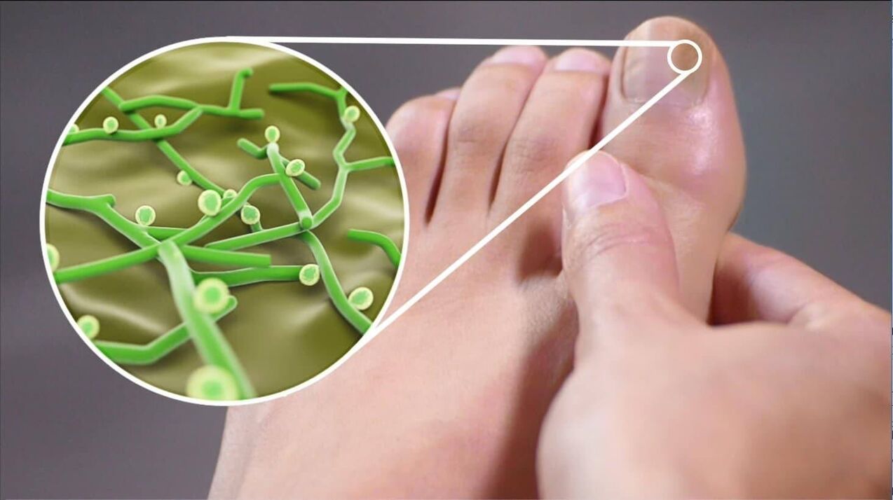 agenți patogeni ai ciupercii unghiilor de la picioare