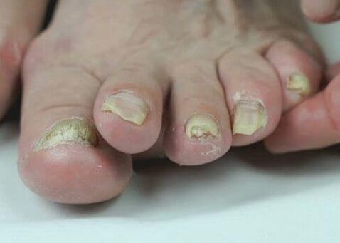 tratamentul ciupercii unghiilor cu medicamente