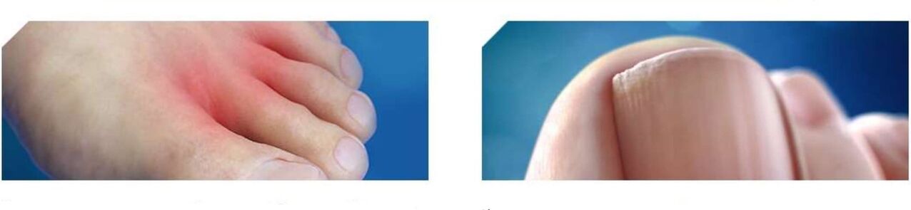 stadiul inițial al ciupercii piciorului